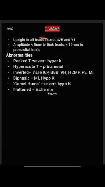 T WAVE 
#easymed #doctor #medicine #india #ecg