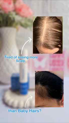 Comment for Link🖇✨️
@be.bodywise
#hairgrowth #serumrollon