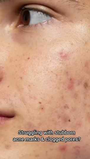 Acne-prone skin? This one's for you 💙✨
My go-to for clogged