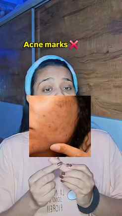 POV: You finally found a serum for those stubborn dark spots