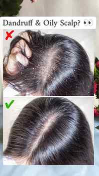 Suffering from Dandruff prone scalp try this 😍 

@ozivera_
