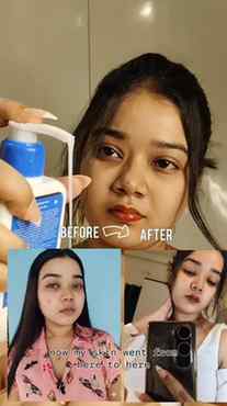 "Game changer" Comment Link 🔗 If you're dealing with "Acne"