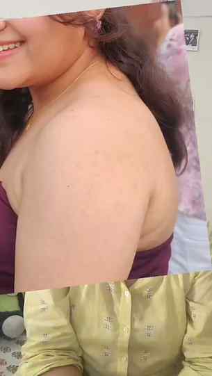 Back acne? Donโt let it stop your outfit game! ๐โจ Try Aquer