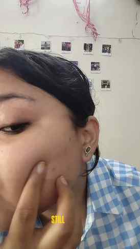 Donโt hide the pimple, treat it! ๐โจ Meet Dermafique Acne Av