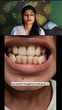 Teeth whitening 
@amazon 
@amazondotin
