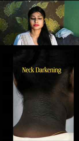 Dark patches
