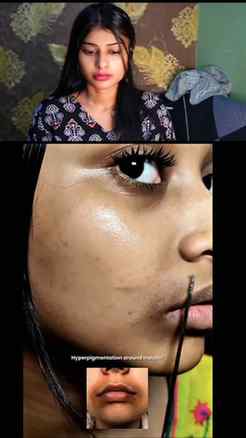 Hyperpigmentation gayab 😱