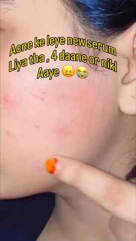 Mai skincare krti hu skin meri care nhi krti #fyp #skin #ski