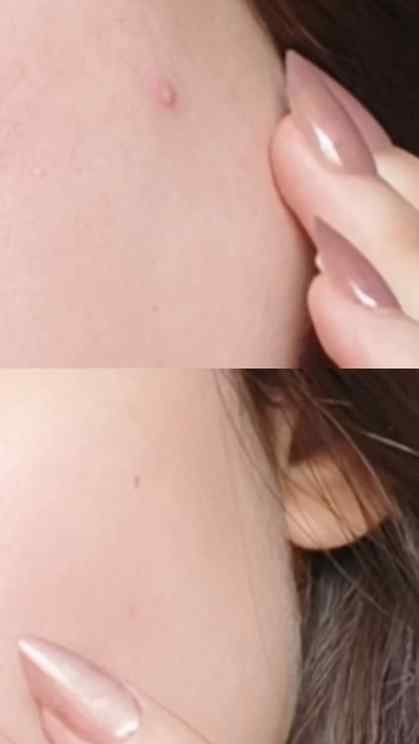 Comment For Link || Novology Acne Rescue Spot Corrector
ski