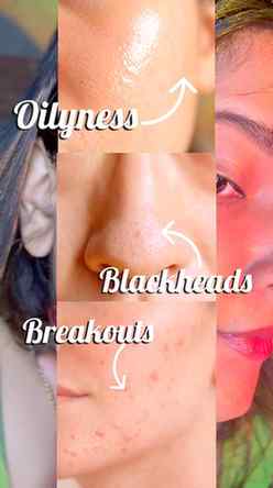Beyond just treating the pimple ✨

Oily, clogged, breakout-p
