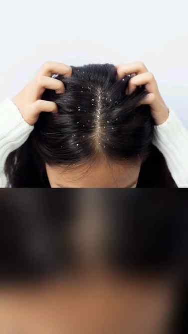 Dandruff care starts with the right hair care routine! ππΏ