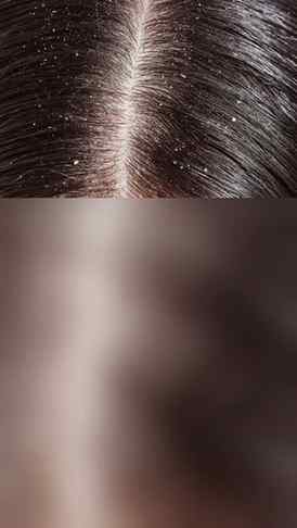Dandruff, itchy scalp & oily buildup? πΏβ¨ Adding the Bare An