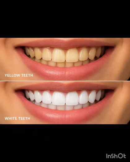 #collobration
From dull - Looking teeth to a brighter Looki