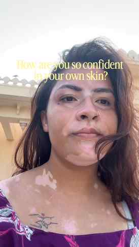 No choice or self love?
#viral #fyp #featured #vitiligo #re
