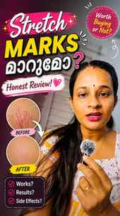 എന്റെ stretch mark കുറയാൻ help ചെയ്തത്🩷
.
.
.
.
#expolre #s