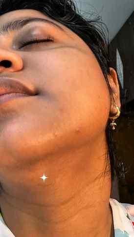 Acne se pareshan ho?
I found this combo ✨
Using Alite Anti