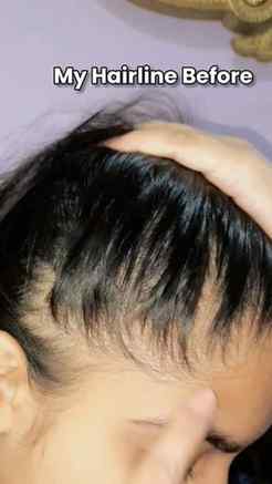 Struggling with hairfall and looking to fast-track your hair