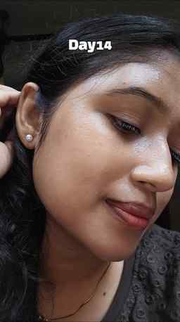 14 days. One serum. Visible difference. 💛 If acne marks are