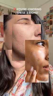 If your skin gets dry again just a few hours after moisturiz