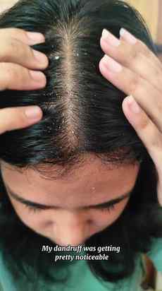 My honest review of WishCare AHA BHA Anti-Dandruff Shampoo..