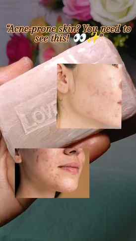 Acne-prone skin care 🫧✨
LOVRIONS Acne Clarifier Soap with S