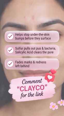 Painful pimples don’t stand a chance!💖
This acne paste has