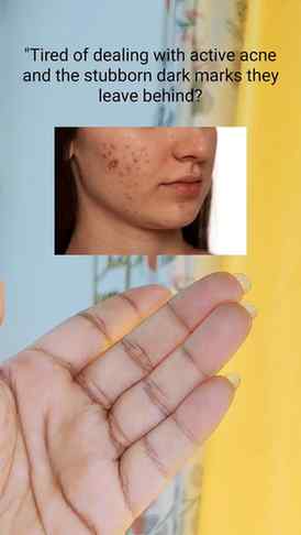 Say goodbye to breakouts, hello to Salicinamide! 👋 by the d