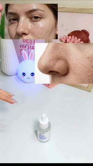 Oily t-zone by 12pm, visible pores + stubborn acne marks 😮