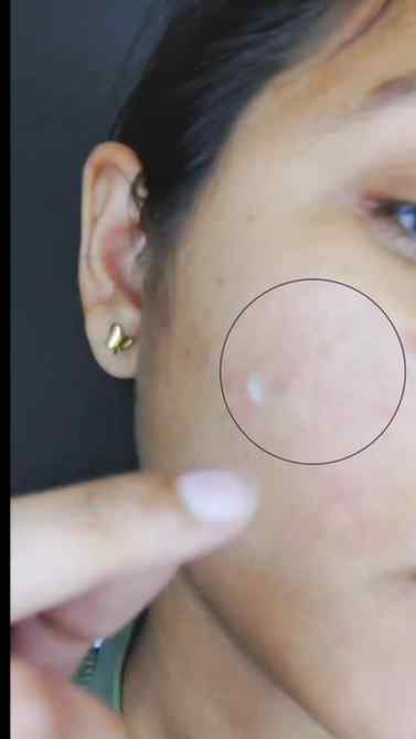 Your acne deserves these!!๐๏ธโจ
(Pimple patches, treatment f