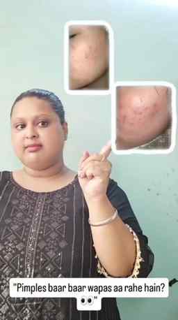 Stop Recurring Acne! 🚫
​If acne and pimples keep coming bac