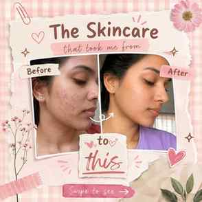 My skincare routine that helped my acne-prone skin look clea