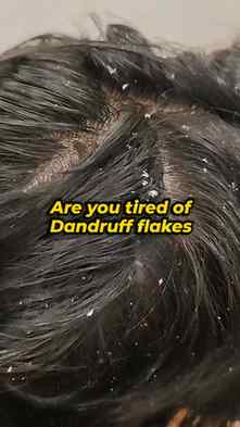 Dandruff, itchy scalp & those annoying flakes? 😩
Time to