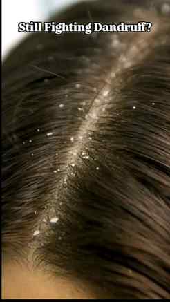 Flakes, itch, and recurring dandruff? Time to upgrade your s