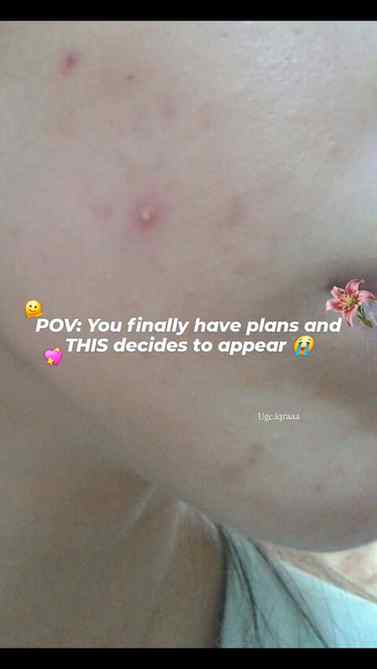 Say bye to pimples before they ruin your day✨️😊
Follow and 