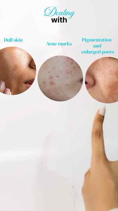 Agar aapko Dark Spots, acne marks, uneven skin tone aur larg