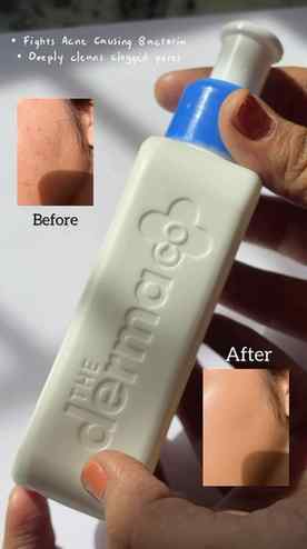 Proof that you can treat active acne without feeling like th